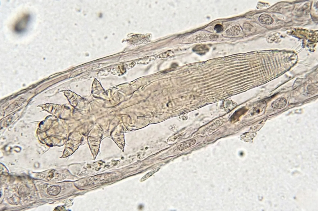 Mikrofotografia przedstawiająca roztocza Demodex (nużeńca) o wydłużonym, przezroczystym ciele i czterech parach krótkich odnóży, znajdującego się wewnątrz mieszka włosowego, widocznego pod mikroskopem świetlnym.