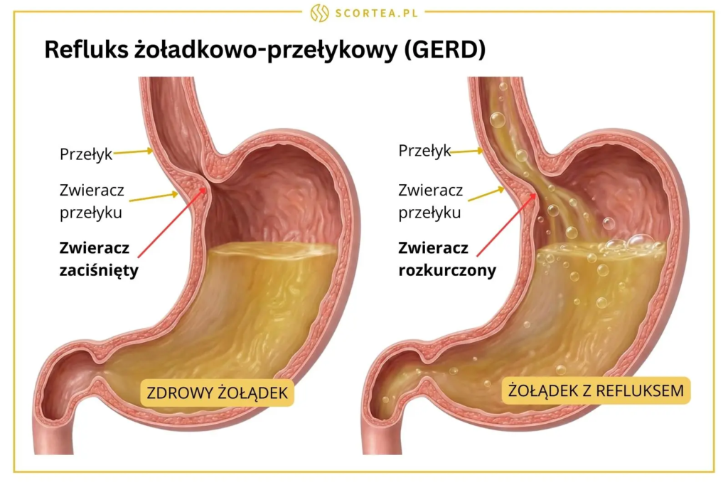 Medyczny schemat porównujący zdrowy żołądek z zaciśniętym zwieraczem oraz żołądek z refluksem (GERD), gdzie rozkurczony zwieracz przepuszcza treść.