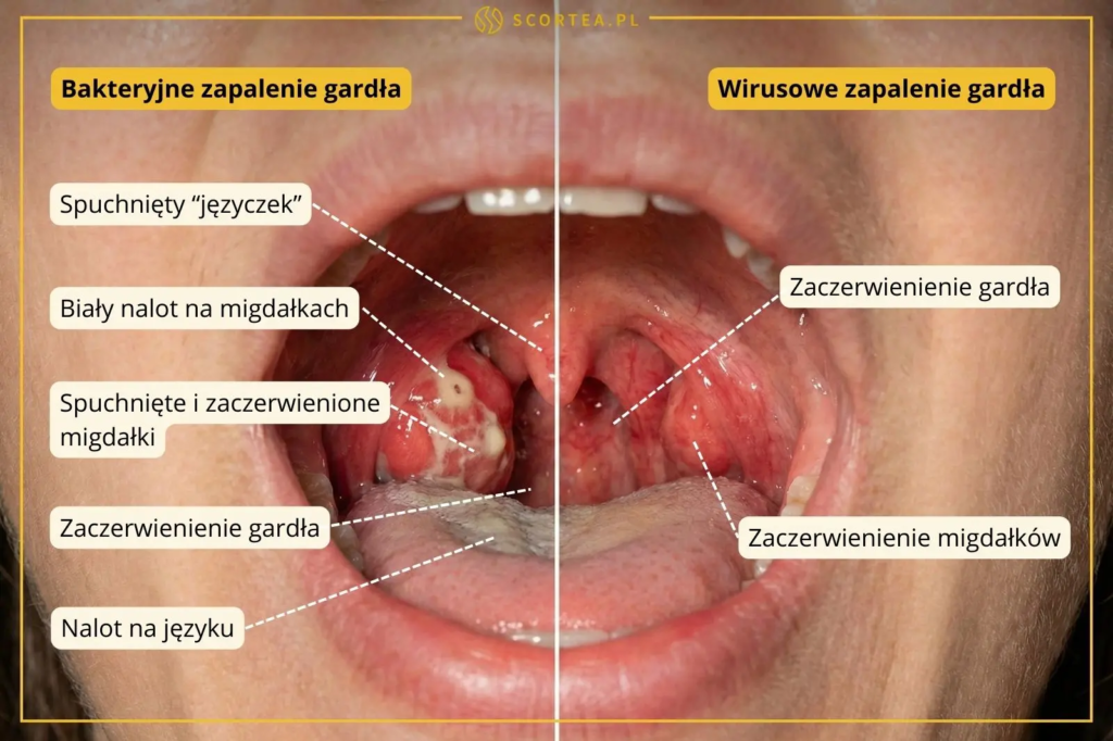 Grafika porównująca objawy bakteryjnego i wirusowego zapalenia gardła. Widoczne różnice w wyglądzie migdałków, języczka oraz obecność białego nalotu.