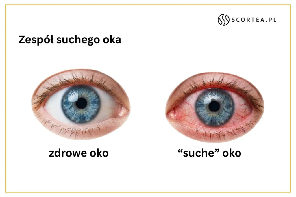 Ilustracja medyczna porównująca zdrowe oko (po lewej) z zaczerwienionym, suchym okiem (po prawej) w ramach zespołu suchego oka. Tekst: "Zespół suchego oka", "zdrowe oko", "suche oko"