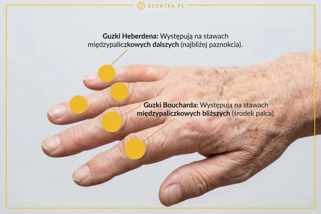 Zbliżenie na dłoń starszej osoby z zaznaczonymi miejscami występowania guzków Heberdena i Boucharda na stawach palców. Edukacyjna grafika medyczna.