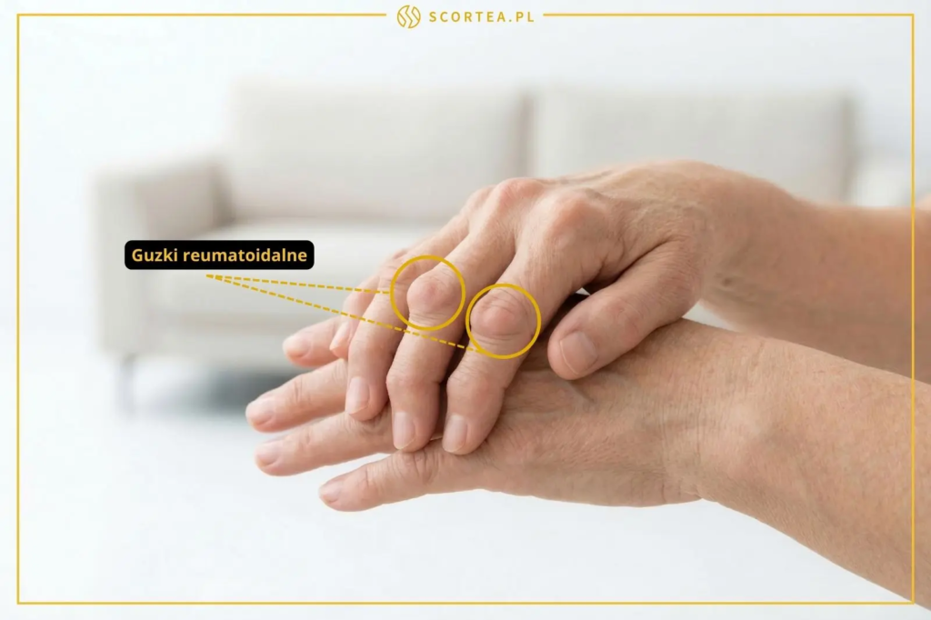 Zbliżenie na dłonie z widocznymi podskórnymi zgrubieniami. Żółte kółko i napis wskazują guzki reumatoidalne na kostkach palców u rąk.