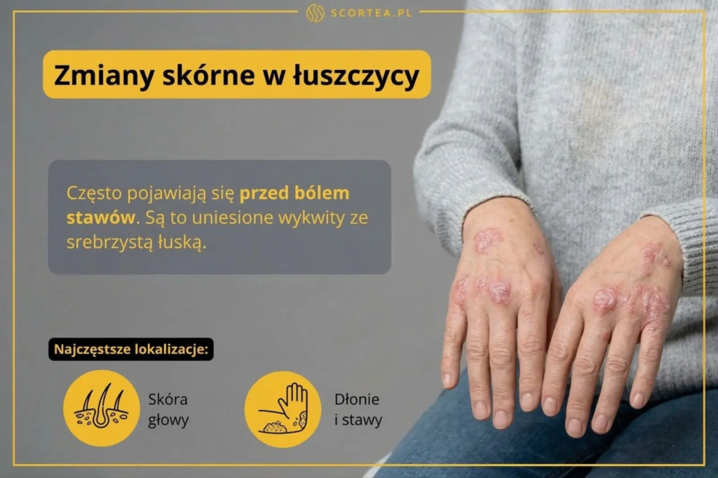 Zbliżenie na dłonie z wykwitami łuszczycowymi w formie uniesionych grudek ze srebrzystą łuską. Grafika zawiera tekst o objawach i lokalizacji zmian.