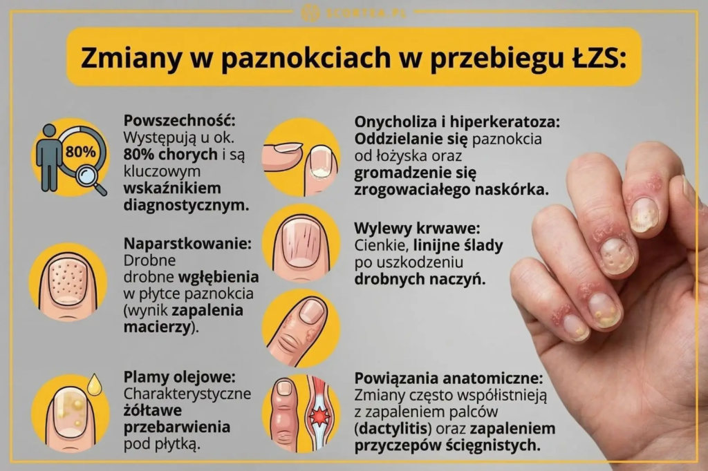 Infografika o zmianach w paznokciach w przebiegu ŁZS. Przedstawia objawy: naparstkowanie, plamy olejowe, onycholizę oraz zdjęcie dłoni ze zmianami.