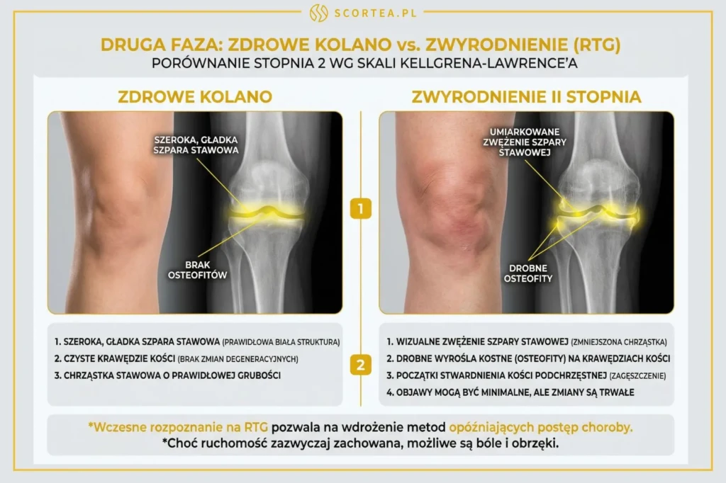 Porównanie obrazu RTG zdrowego stawu kolanowego oraz stawu ze zmianami zwyrodnieniowymi: widoczne osteofity i zwężenie szpary stawowej.