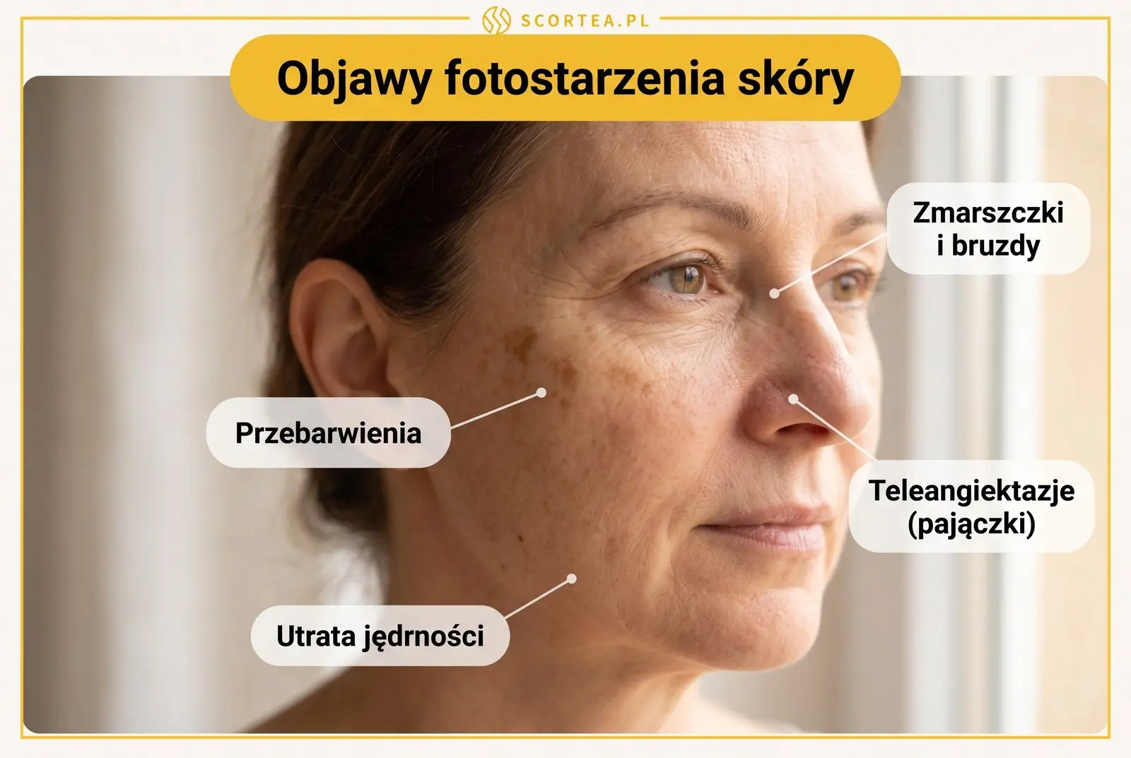 Twarz dojrzałej kobiety z zaznaczonymi objawami fotostarzenia skóry: zmarszczki i bruzdy, przebarwienia, teleangiektazje oraz utrata jędrności.