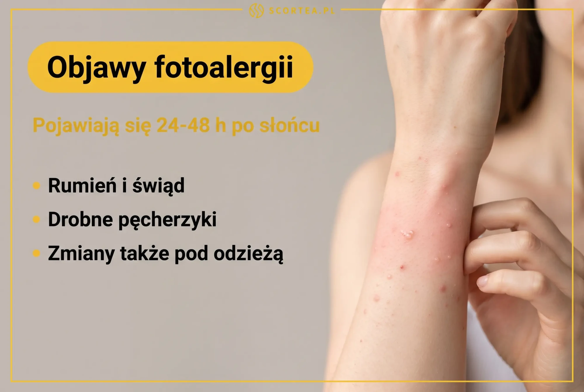 Objawy fotoalergii na przedramieniu: rumień, świąd i drobne pęcherzyki pojawiające się 24-48 godzin po słońcu