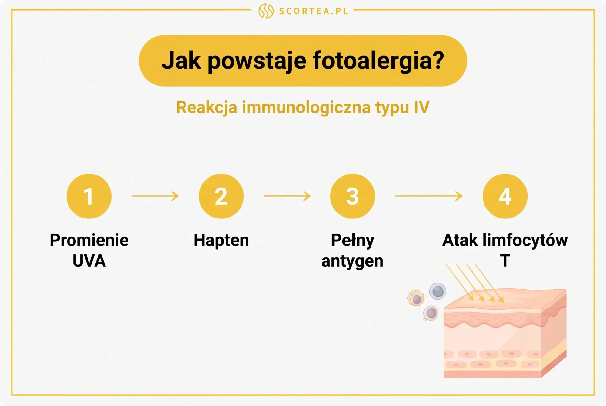 Schemat powstawania fotoalergii jako reakcji immunologicznej typu IV: promienie UVA, hapten, pełny antygen, atak limfocytów T
