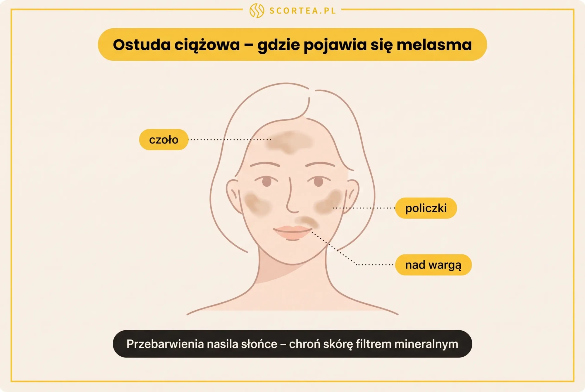 Infografika Scortea: ostuda ciążowa (melasma) – przebarwienia na czole, policzkach i nad górną wargą nasilane przez słońce