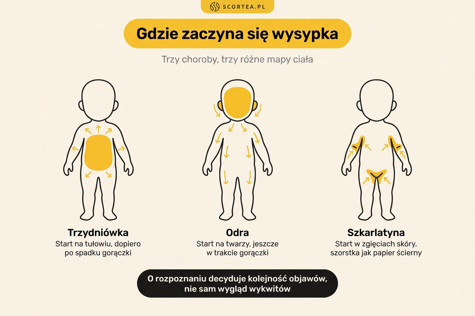 Infografika: mapy ciała pokazujące, gdzie zaczyna się wysypka w trzydniówce, odrze i szkarlatynie